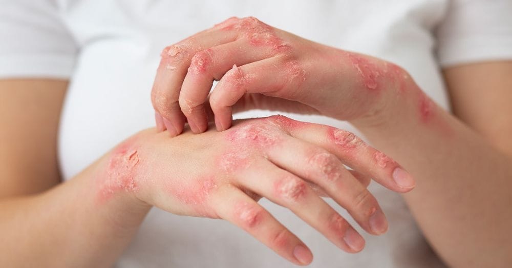 Epidermolise bolhosa Martins advogados