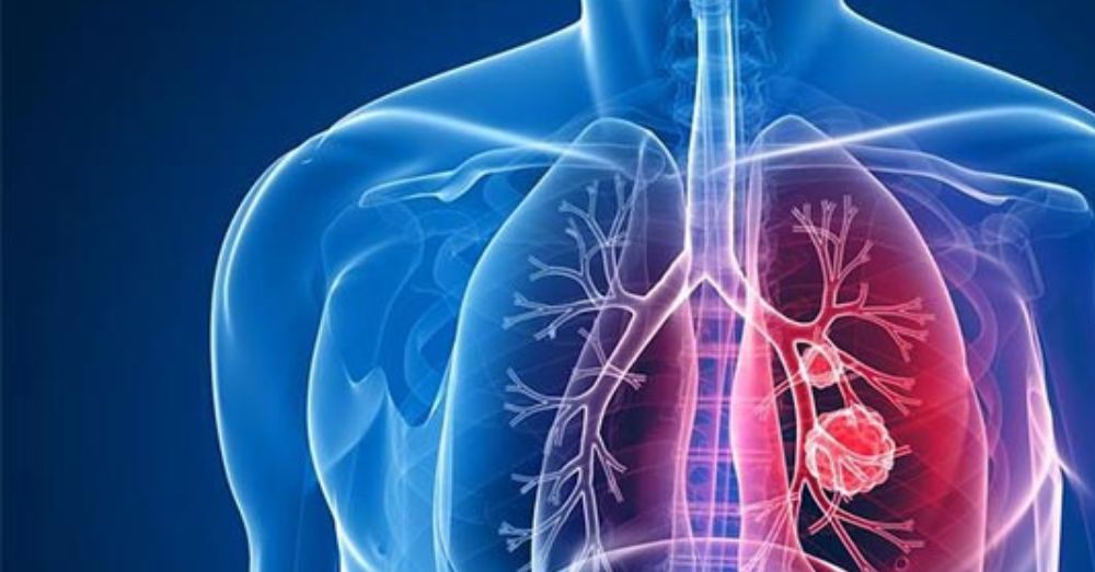 Sequelas Pulmonares - Martins Advogados